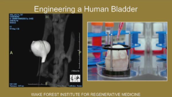 Printing a Human Bladder